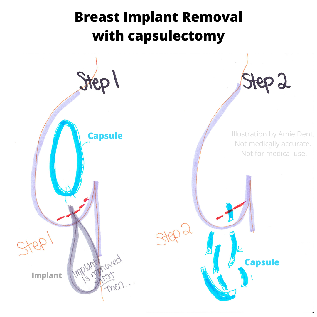 Breast Implant Illness BII: Home